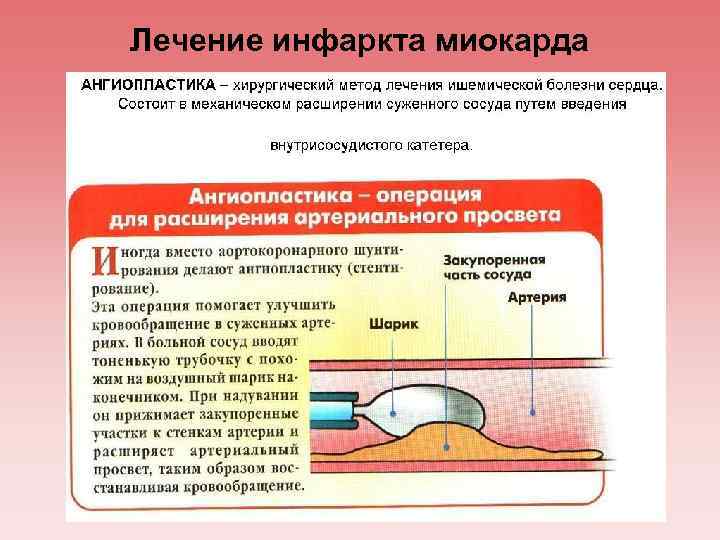 Лечение инфаркта миокарда 