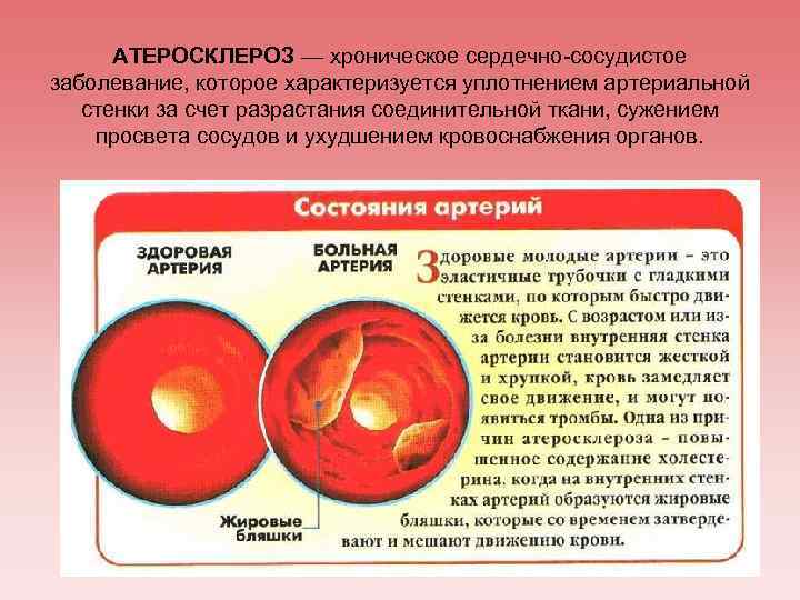 АТЕРОСКЛЕРОЗ — хроническое сердечно-сосудистое заболевание, которое характеризуется уплотнением артериальной стенки за счет разрастания соединительной