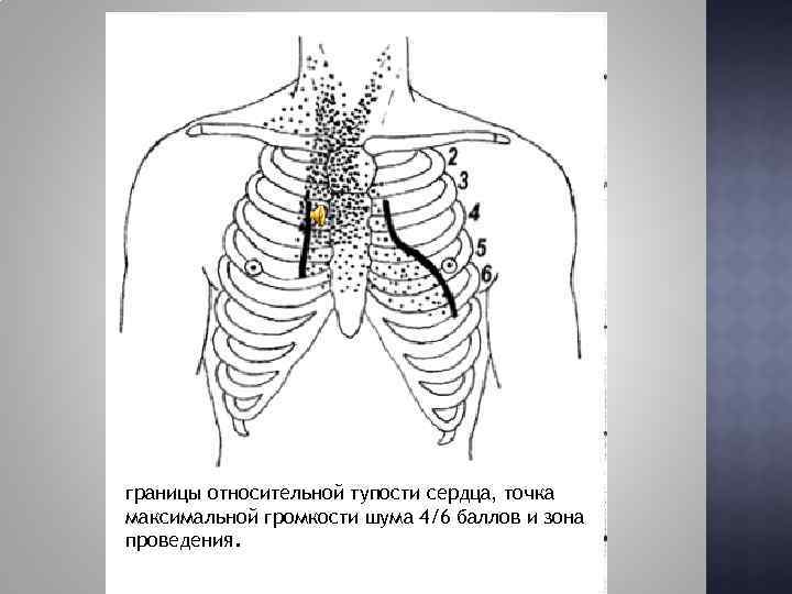 границы относительной тупости сердца, точка максимальной громкости шума 4/6 баллов и зона проведения. 