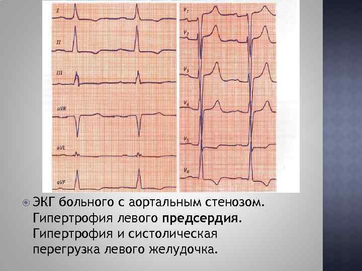  ЭКГ больного с аортальным стенозом. Гипертрофия левого предсердия. Гипертрофия и систолическая перегрузка левого