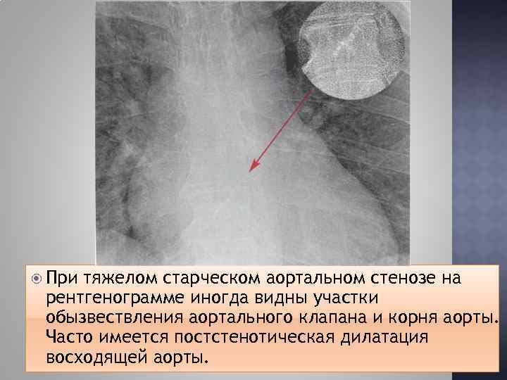  При тяжелом старческом аортальном стенозе на рентгенограмме иногда видны участки обызвествления аортального клапана