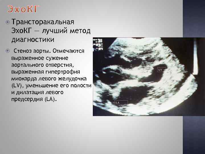  Трансторакальная Эхо. КГ — лучший метод диагностики Стеноз аорты. Отмечаются выраженное сужение аортального