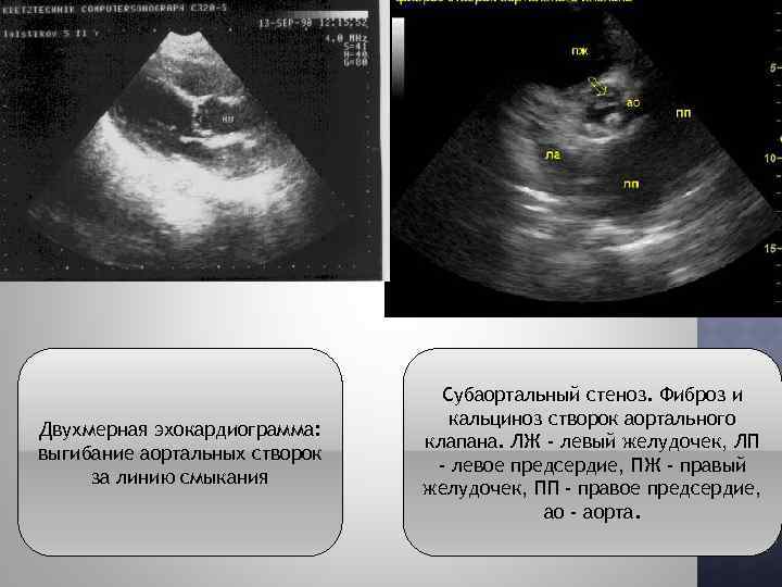 Двухмерная эхокардиограмма: выгибание аортальных створок за линию смыкания Субаортальный стеноз. Фиброз и кальциноз створок