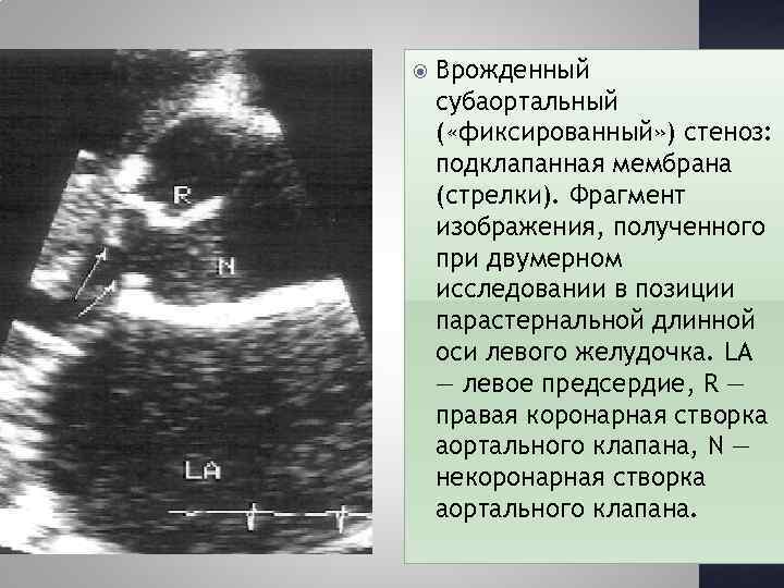  Врожденный субаортальный ( «фиксированный» ) стеноз: подклапанная мембрана (стрелки). Фрагмент изображения, полученного при