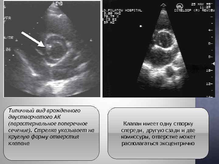 Типичный вид врожденного двустворчатого АК (парастернальное поперечное сечение). Стрелка указывает на круглую форму отверстия