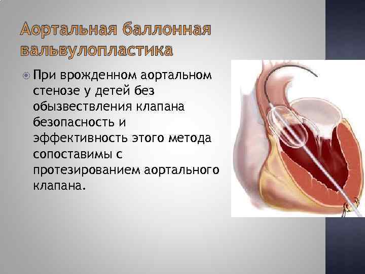 Аортальная баллонная вальвулопластика При врожденном аортальном стенозе у детей без обызвествления клапана безопасность и