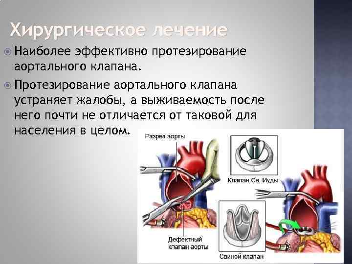 Расчет площади аортального клапана