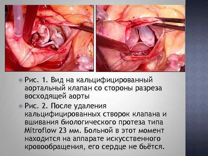  Рис. 1. Вид на кальцифицированный аортальный клапан со стороны разреза восходящей аорты Рис.