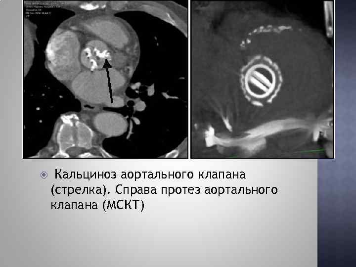  Кальциноз аортального клапана (стрелка). Справа протез аортального клапана (МСКТ) 