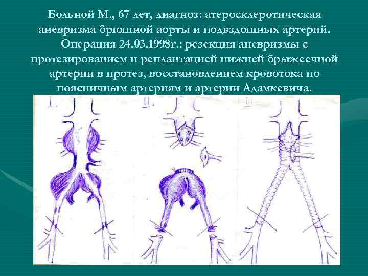 Больной М. , 67 лет, диагноз: атеросклеротическая аневризма брюшной аорты и подвздошных артерий. Операция