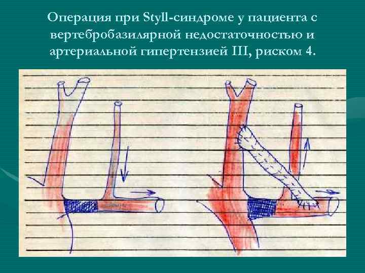 Операция при Styll-синдроме у пациента с вертебробазилярной недостаточностью и артериальной гипертензией III, риском 4.