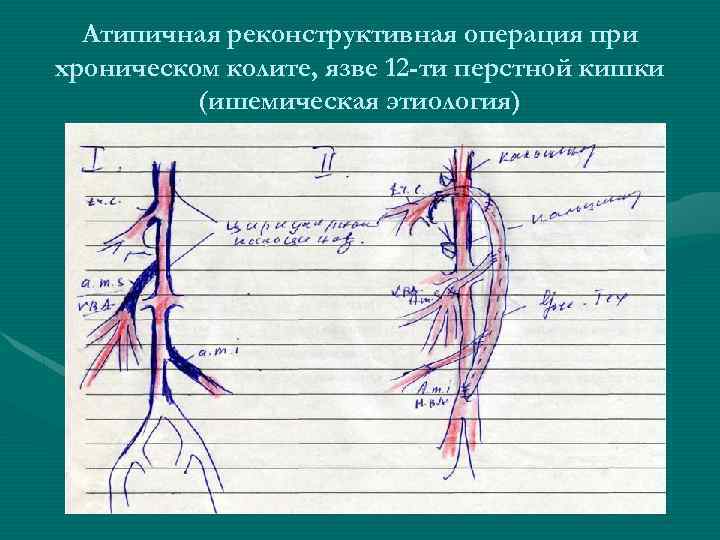 Атипичная реконструктивная операция при хроническом колите, язве 12 -ти перстной кишки (ишемическая этиология) 