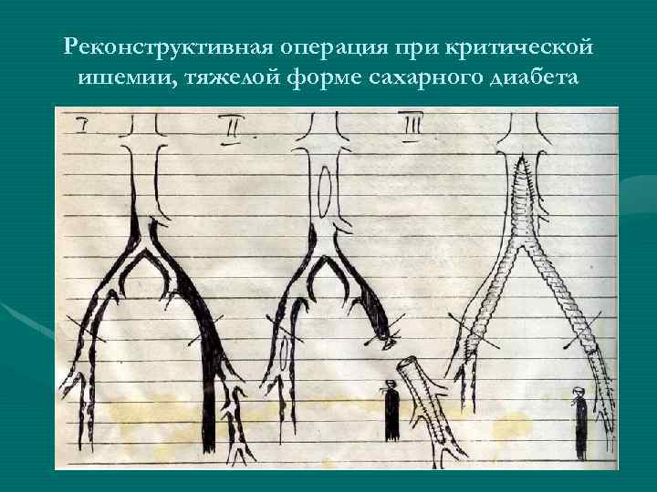 Реконструктивная операция при критической ишемии, тяжелой форме сахарного диабета 