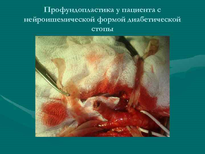 Профундопластика у пациента с нейроишемической формой диабетической стопы 