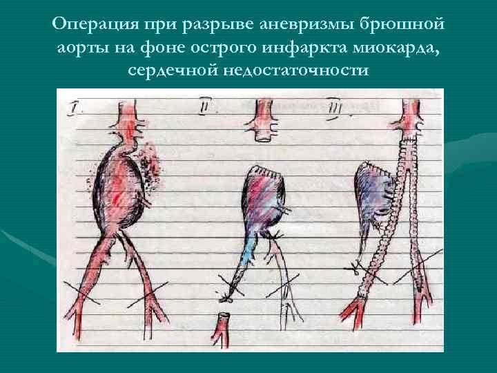 Операция при разрыве аневризмы брюшной аорты на фоне острого инфаркта миокарда, сердечной недостаточности 