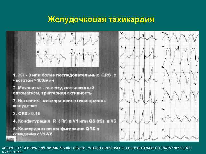 Желудочковая тахикардия Adapted from: Дж. Кэмм и др. Болезни сердца и сосудов. Руководство Европейского