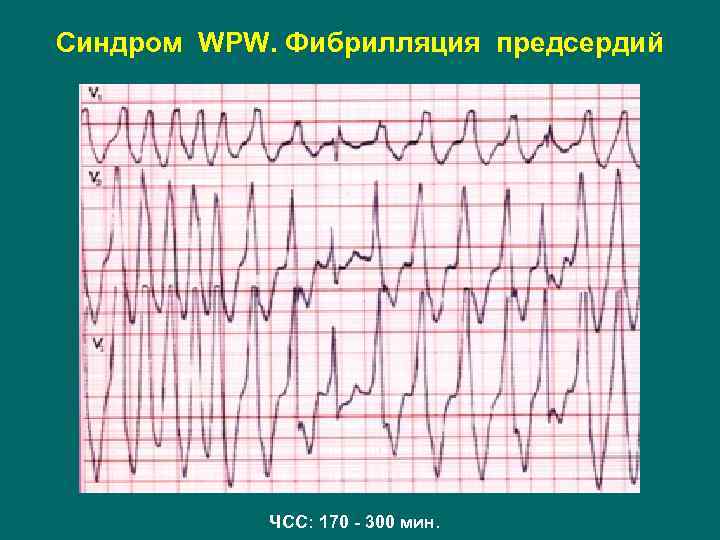 Синдром WPW. Фибрилляция предсердий ЧСС: 170 - 300 в мин. ЧСС: 170 - 300