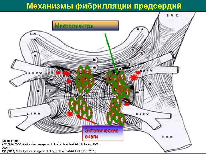 Механизмы фибрилляции предсердий Adapted from: ACC /AHA/ESC Guidelines for management of patients with atrial