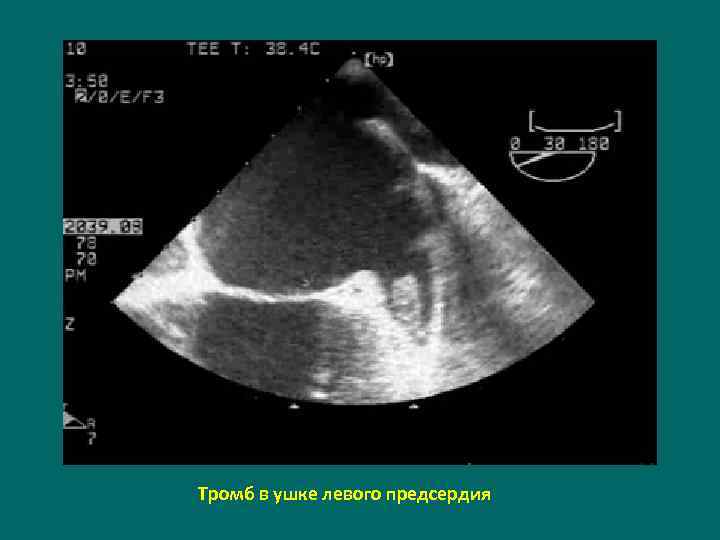 Тромб в ушке левого предсердия 