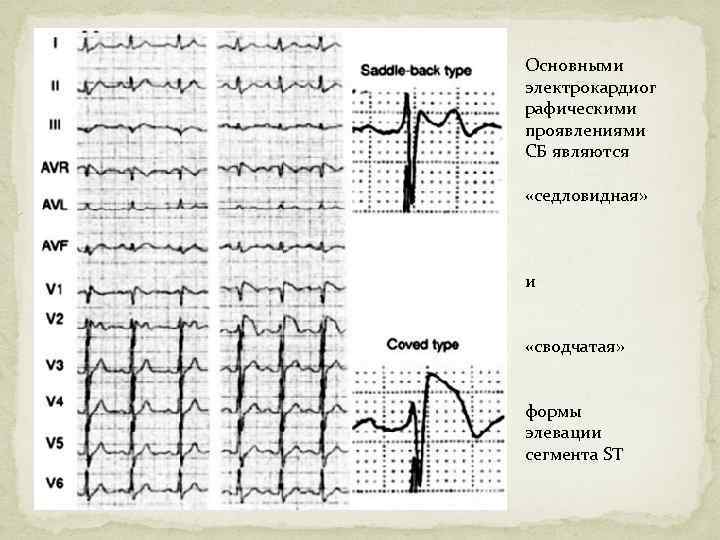 Основными электрокардиог рафическими проявлениями СБ являются «седловидная» и «сводчатая» формы элевации сегмента ST 