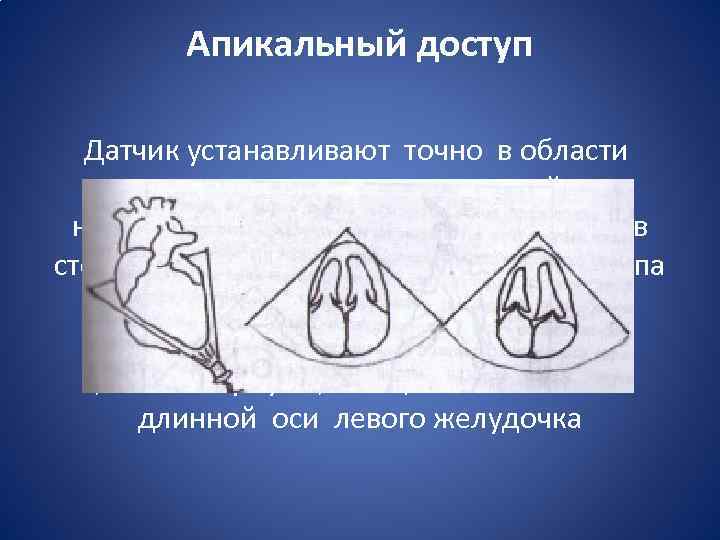 Апикальный доступ Датчик устанавливают точно в области верхушки сердца, ультразвуковой луч направляют вверх и