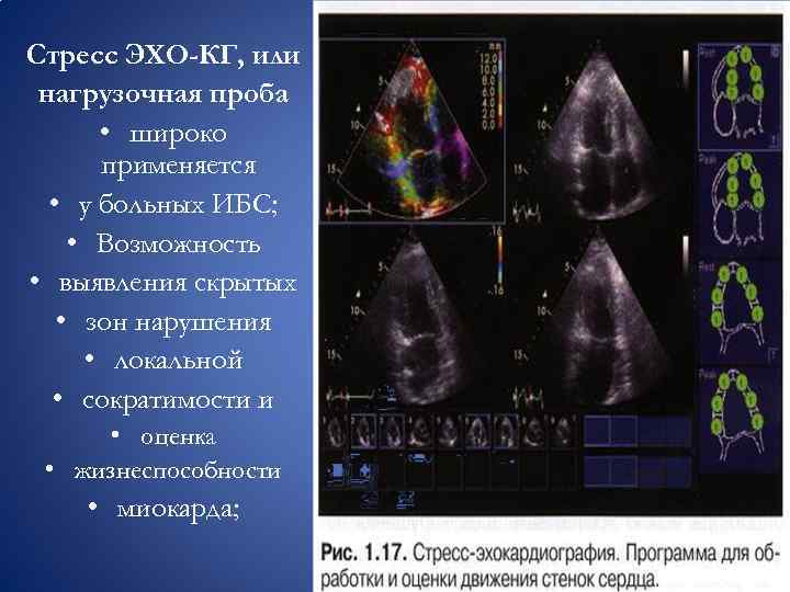 Стресс ЭХО-КГ, или нагрузочная проба • широко применяется • у больных ИБС; • Возможность