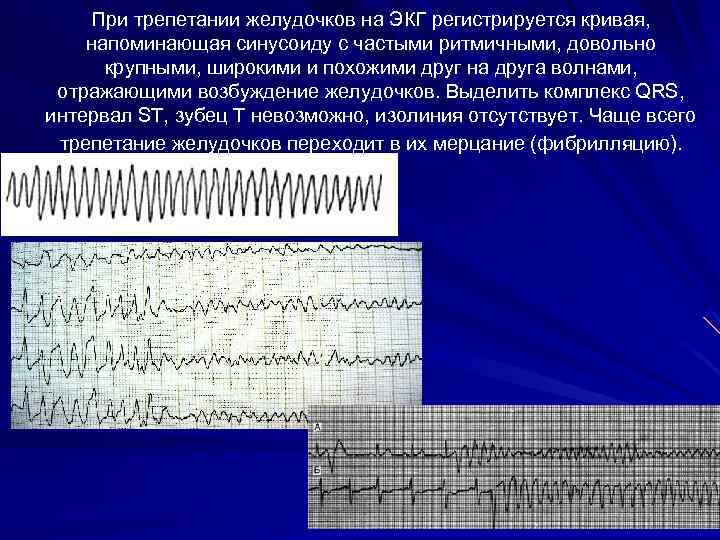 При трепетании желудочков на ЭКГ регистрируется кривая, напоминающая синусоиду с частыми ритмичными, довольно крупными,