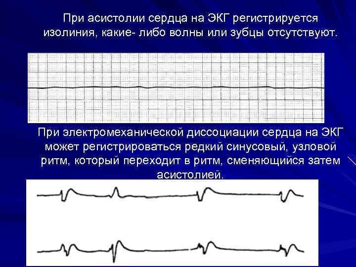 При асистолии сердца на ЭКГ регистрируется изолиния, какие- либо волны или зубцы отсутствуют. При
