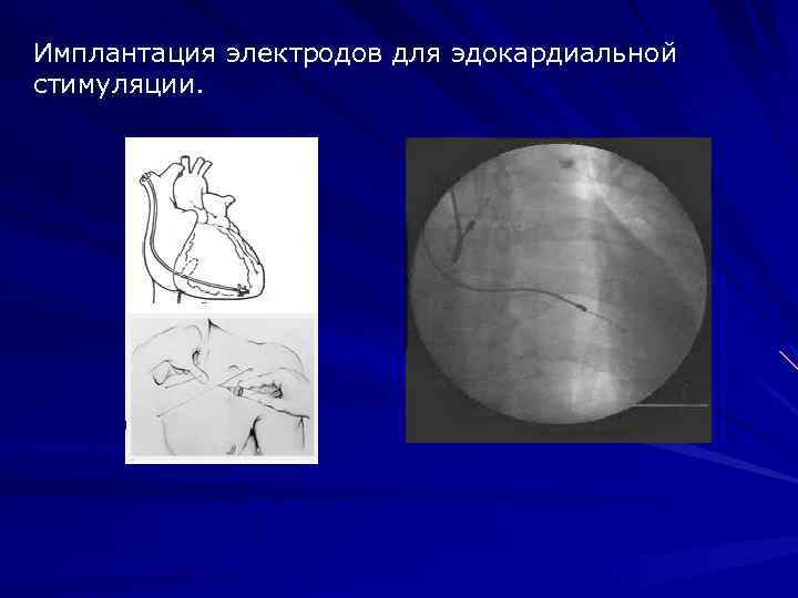 Имплантация электродов для эдокардиальной стимуляции. 