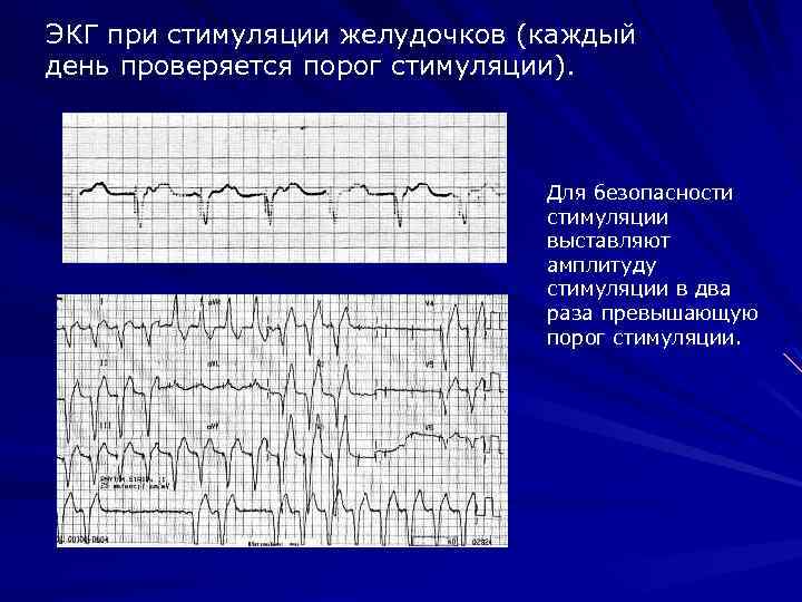 ЭКГ при стимуляции желудочков (каждый день проверяется порог стимуляции). Для безопасности стимуляции выставляют амплитуду