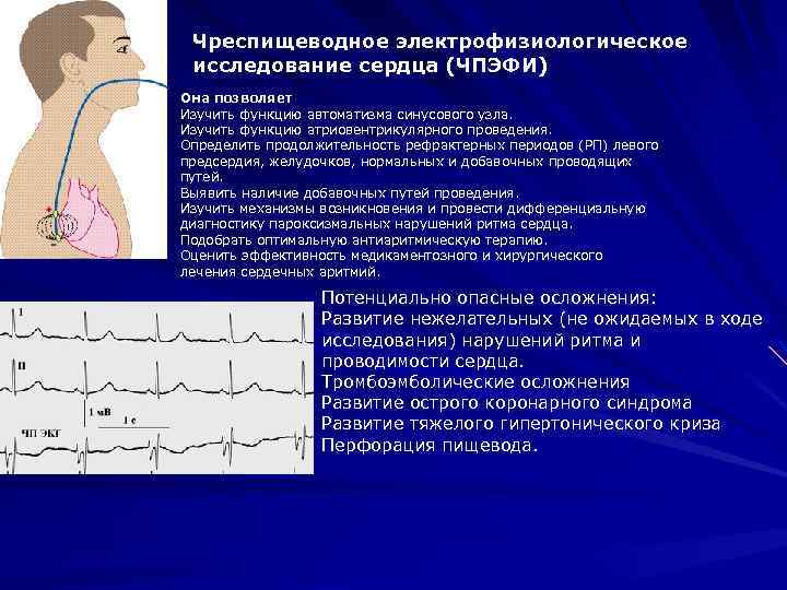 Чреспищеводное электрофизиологическое исследование сердца (ЧПЭФИ) Она позволяет Изучить функцию автоматизма синусового узла. Изучить функцию