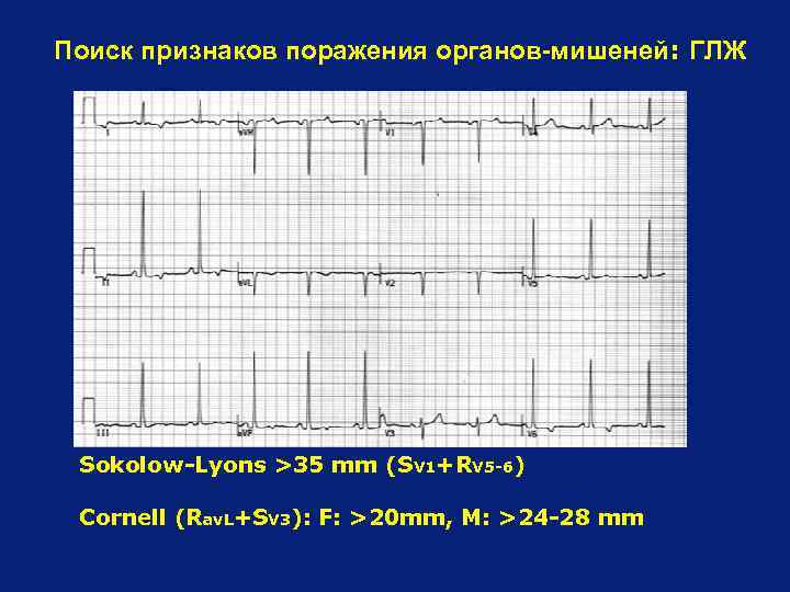 Поиск признаков поражения органов-мишеней: ГЛЖ Sokolow-Lyons >35 mm (SV 1+RV 5 -6) Cornell (Rav.