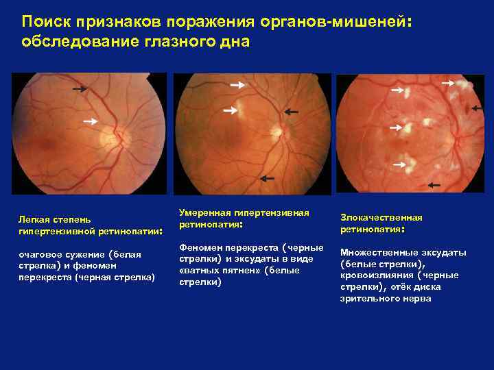 Поиск признаков поражения органов-мишеней: обследование глазного дна Легкая степень гипертензивной ретинопатии: очаговое сужение (белая