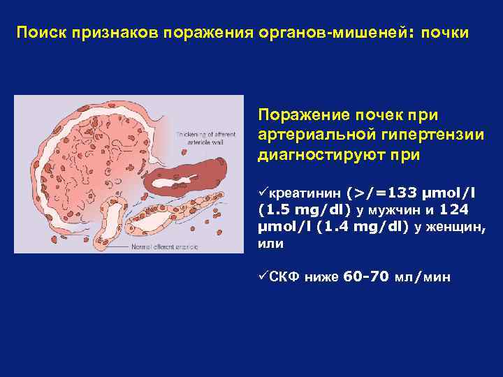 Поиск признаков поражения органов-мишеней: почки Поражение почек при артериальной гипертензии диагностируют при üкреатинин (>/=133