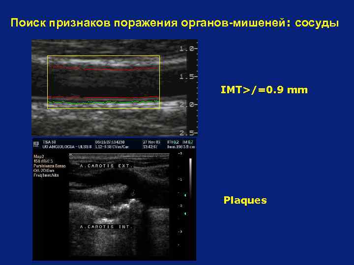 Поиск признаков поражения органов-мишеней: сосуды IMT>/=0. 9 mm Plaques 