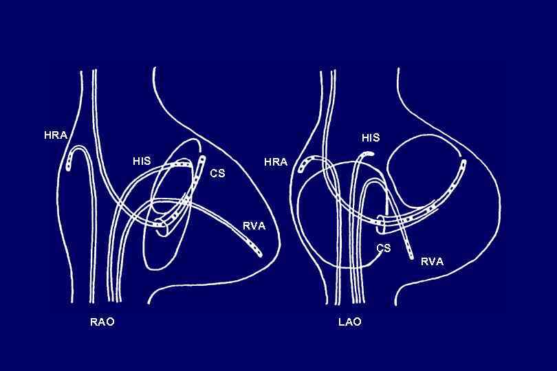 HRA HIS CS HRA RVA CS RVA RAO LAO 