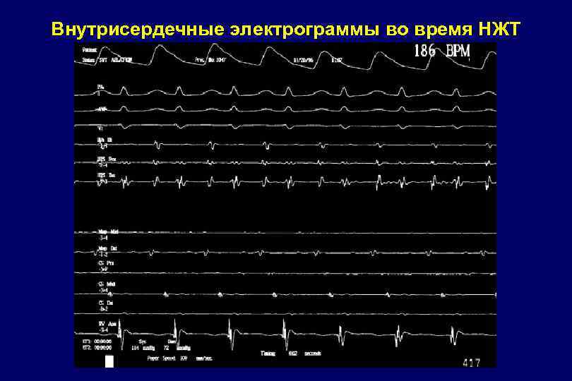 Внутрисердечные электрограммы во время НЖТ 