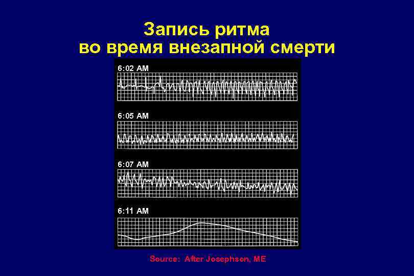 Запись ритма во время внезапной смерти 6: 02 AM 6: 05 AM 6: 07