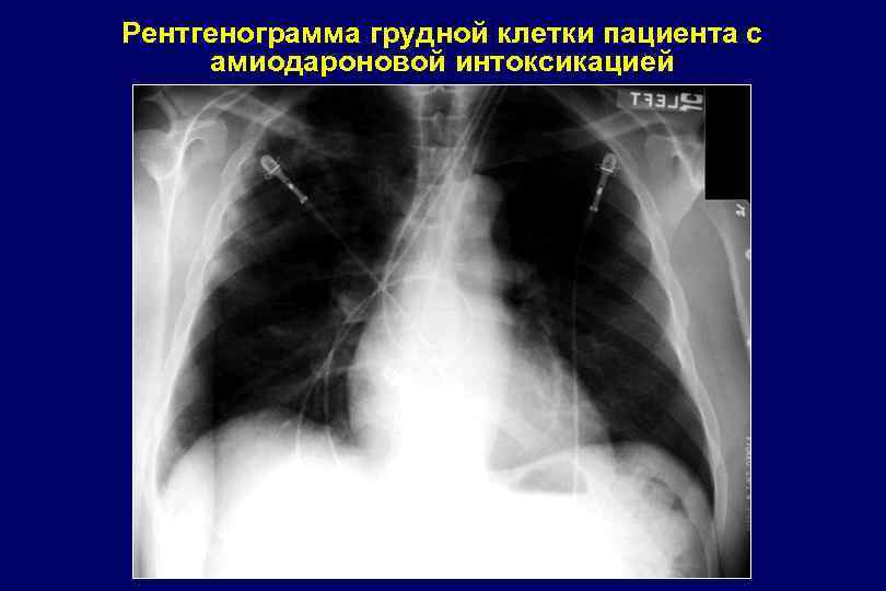 Рентгенограмма грудной клетки пациента с амиодароновой интоксикацией 