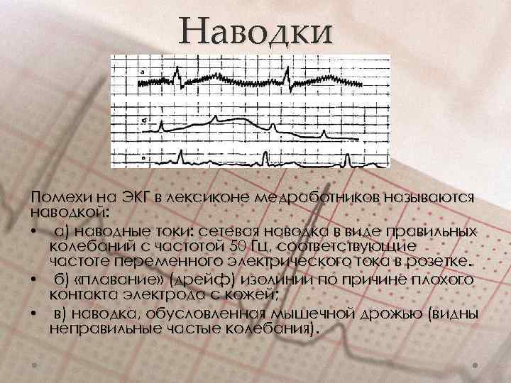 Наводки Помехи на ЭКГ в лексиконе медработников называются наводкой: • а) наводные токи: сетевая