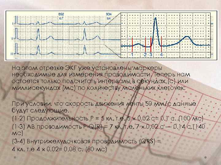 На этом отрезке ЭКГ уже установлены маркеры необходимые для измерения проводимости. Теперь нам остается