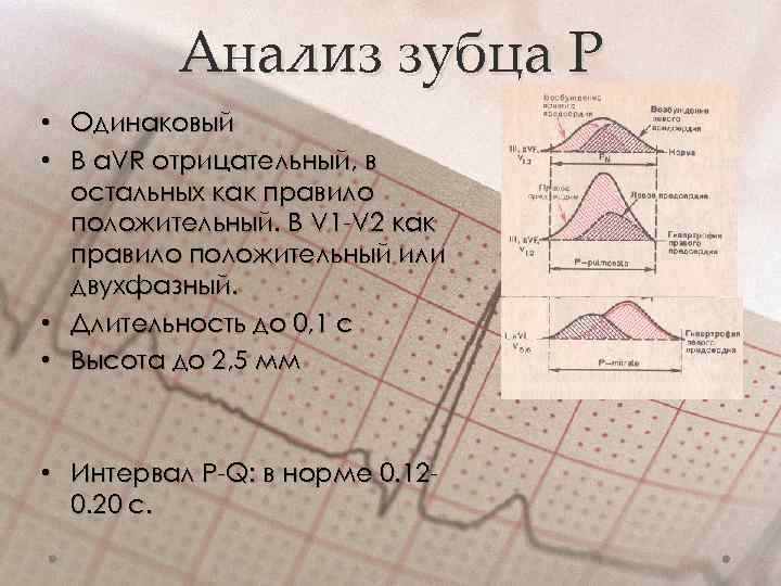 Анализ зубца Р • Одинаковый • В a. VR отрицательный, в остальных как правило