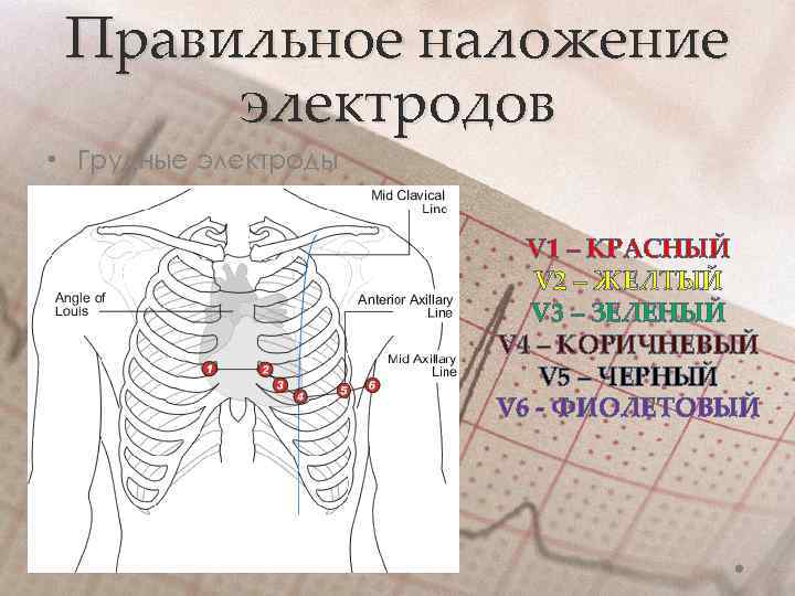 Правильное наложение электродов • Грудные электроды V 1 – КРАСНЫЙ V 2 – ЖЕЛТЫЙ