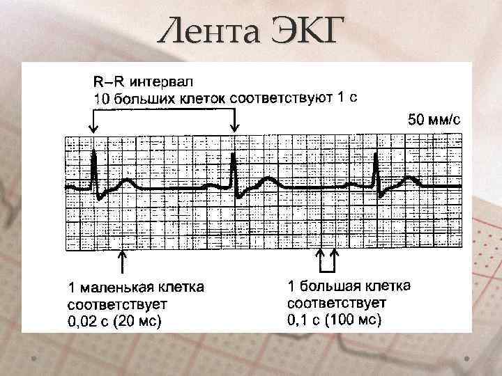 Лента ЭКГ 