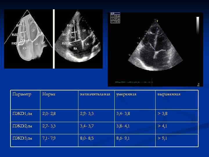 Параметр Норма незначительная умеренная выраженная ПЖD 1, см 2, 0 - 2, 8 2,