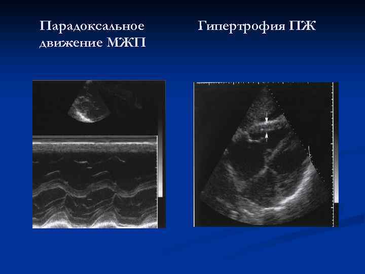Парадоксальное движение МЖП Гипертрофия ПЖ 