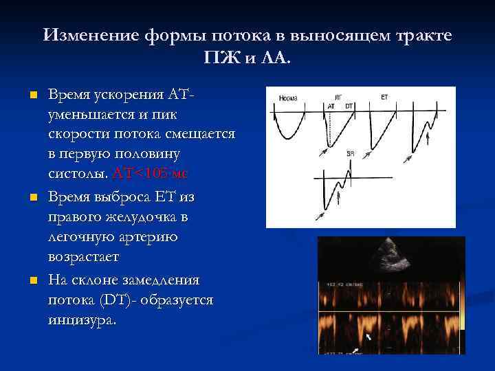 Изменение формы потока в выносящем тракте ПЖ и ЛА. n n n Время ускорения