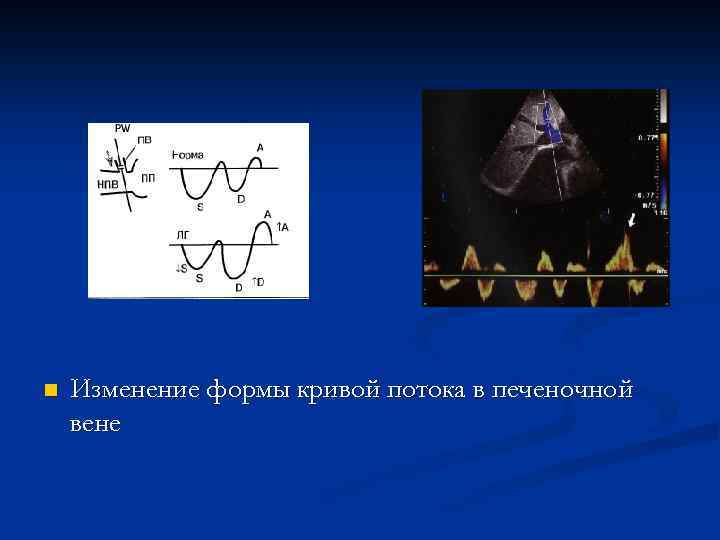 n Изменение формы кривой потока в печеночной вене 