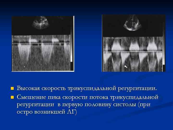 n n Высокая скорость трикуспидальной регургитации. Смещение пика скорости потока трикуспидальной регургитации в первую