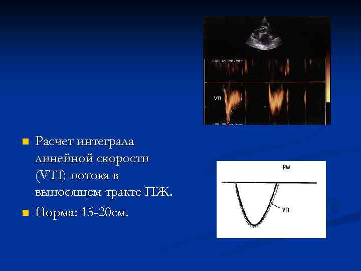 n n Расчет интеграла линейной скорости (VTI) потока в выносящем тракте ПЖ. Норма: 15